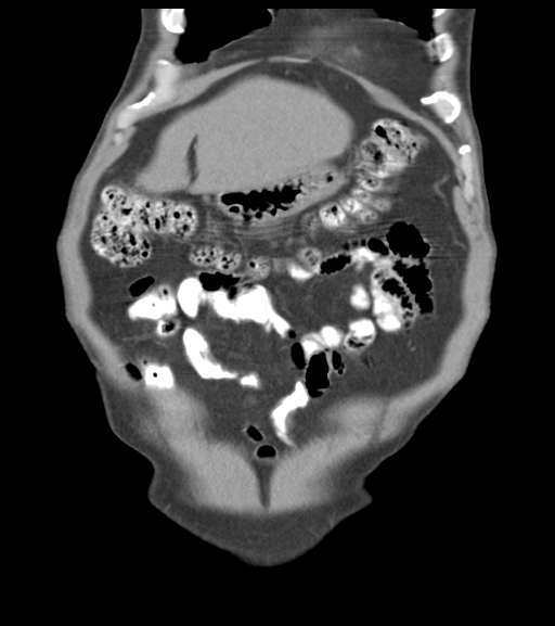 File:Appendiceal abscesses (Radiopaedia 50999-56542 Coronal non-contrast 15).png