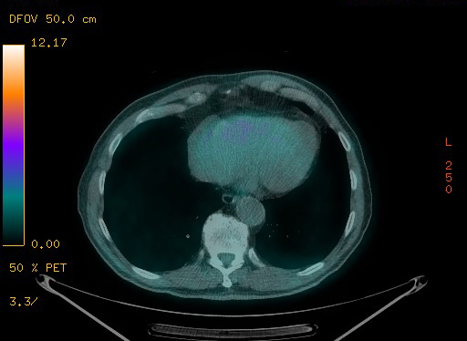 Appendiceal adenocarcinoma complicated by retroperitoneal abscess (Radiopaedia 58007-65041 Axial PET-CT 92).jpg
