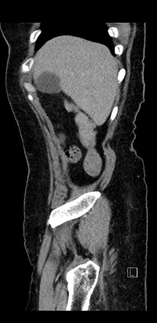 Appendiceal hemorrhage (Radiopaedia 70830-81025 E 10).jpg