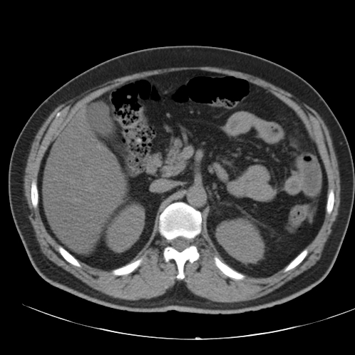 File:Appendicitis and giant appendicolith (Radiopaedia 80251-93588 Axial non-contrast 16).jpg