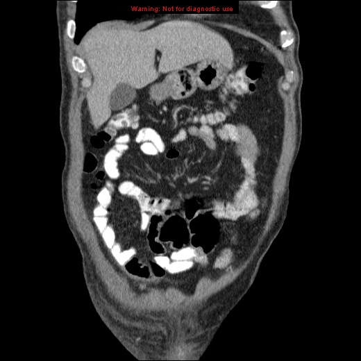 File:Appendicitis mass in inguinal hernia (Radiopaedia 26858-27029 B 12).jpg
