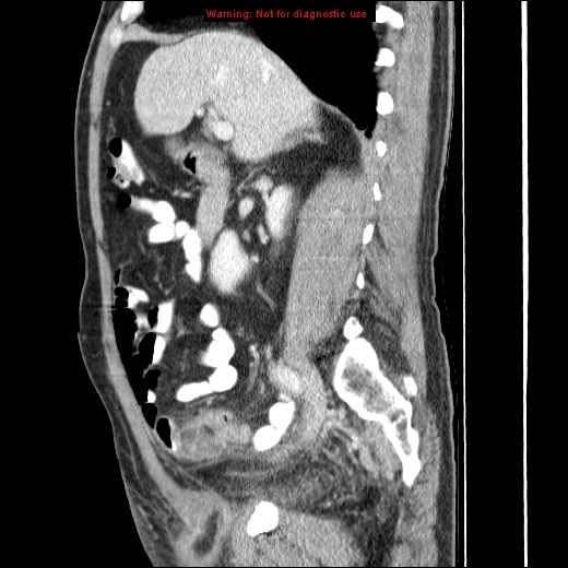 File:Appendicitis mass in inguinal hernia (Radiopaedia 26858-27029 C 20).jpg