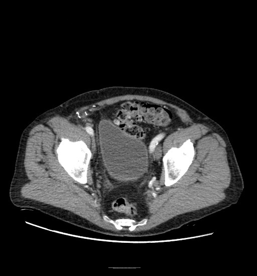 Appendicitis with localized perforation and abscess formation (Radiopaedia 49035-54130 A 76).jpg
