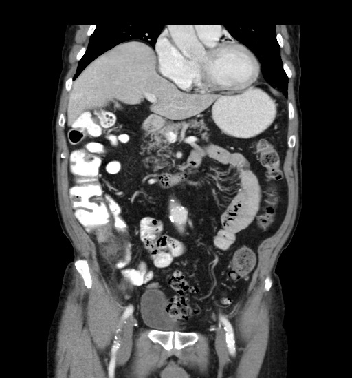Appendicitis with localized perforation and abscess formation (Radiopaedia 49035-54130 B 20).jpg