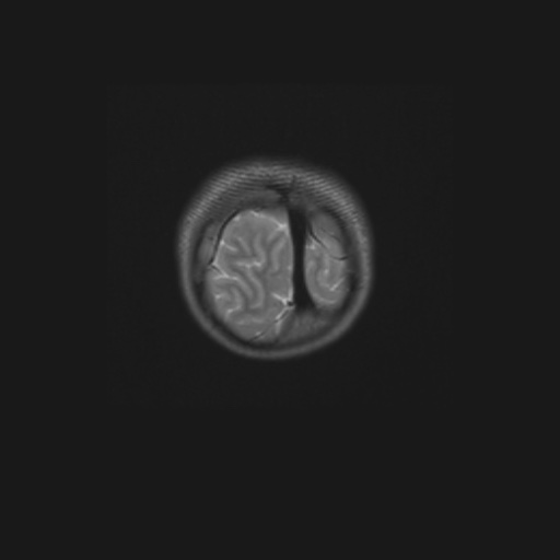 Aqueduct stenosis (Radiopaedia 52453-58460 Coronal T2 3).jpg