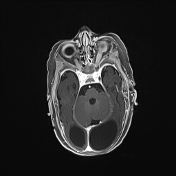 Aqueductal stenosis (Radiopaedia 73974-84802 Axial T1 C+ 59).jpg