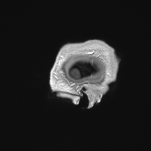 Arachnoid cyst with subdural hematoma (Radiopaedia 85892-101743 Sagittal T1 C+ 6).png