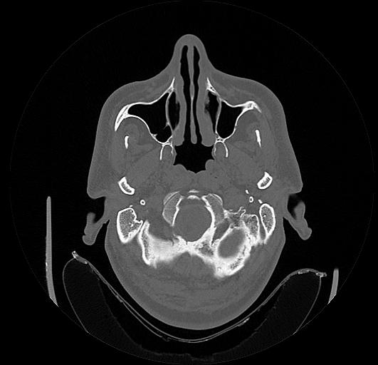 Arcuate foramen (Radiopaedia 89833-106944 Axial bone window 2).jpg