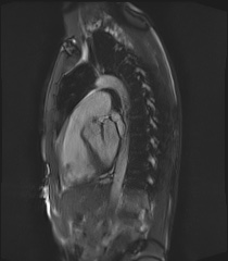File:Arrhythmogenic right ventricular cardiomyopathy (Radiopaedia 57972-64966 Cine RVOT SSFP 10).jpg