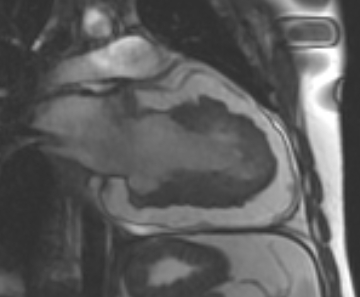 Arrhythmogenic right ventricular cardiomyopathy (Radiopaedia 69431-79307 2ch cine 8).jpg