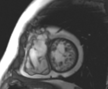 Arrhythmogenic right ventricular cardiomyopathy (Radiopaedia 69431-79307 Short axis cine 80).jpg