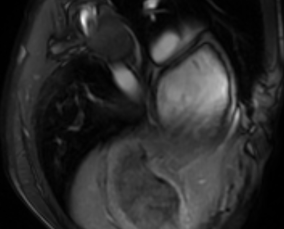 Arrhythmogenic right ventricular cardiomyopathy (Radiopaedia 69564-79464 4ch cine 155).jpg