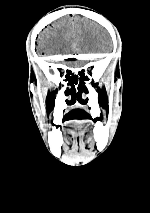 Arrow injury to the brain (Radiopaedia 72101-82607 Coronal non-contrast 28).jpg