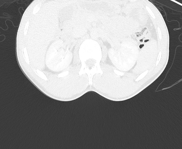 File:Arrow injury to the chest (Radiopaedia 75223-86321 Axial lung window 121).jpg