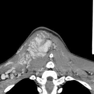 Arteriovenous malformation of the neck (Radiopaedia 53935-60062 D 49).jpg