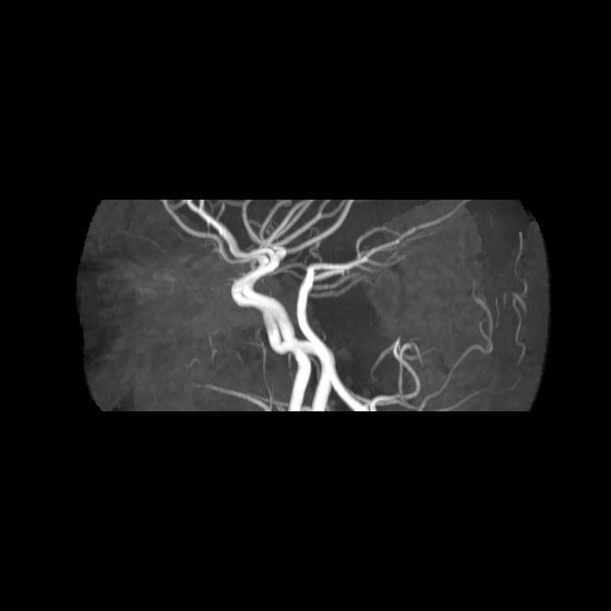 File:Artery of Percheron infarct (Radiopaedia 40966-43676 G 57).jpg