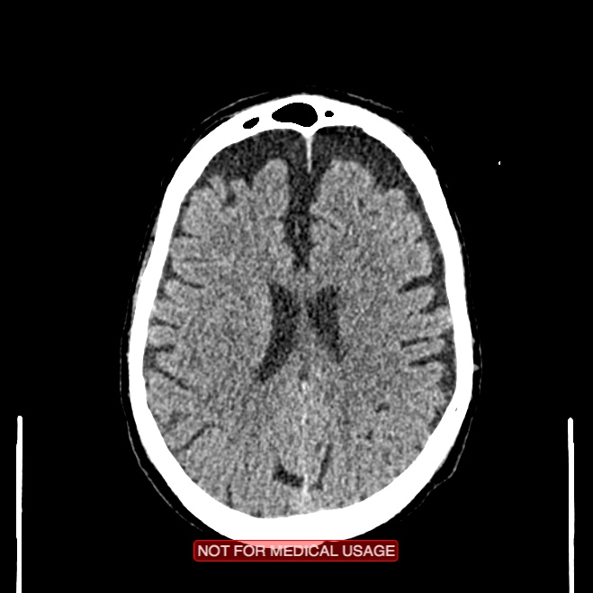Artery of Percheron infarction (Radiopaedia 28679-28967 Axial non-contrast 77).jpg