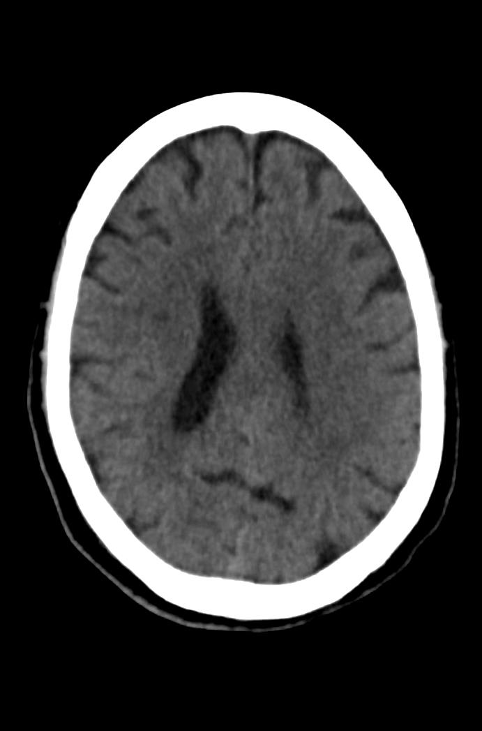 Artery of Percheron infarction (Radiopaedia 80613-94202 Axial non-contrast 124).jpg