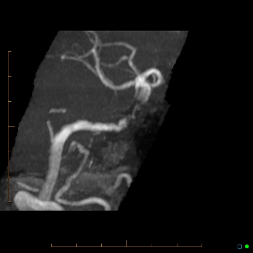 File:Artifactual basilar artery stenosis due to metallic stent (Radiopaedia 31206-31922 3D MIP 9).jpg