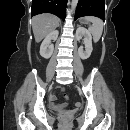 File:Ascending colon diverticulitis (Radiopaedia 61970-70040 B 41).jpg