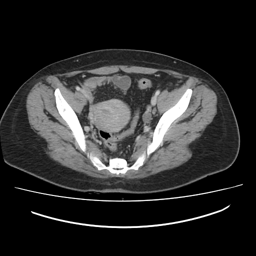 Ascending retrocecal appendicitis with liver abscesses (Radiopaedia 60066-67615 B 76).jpg