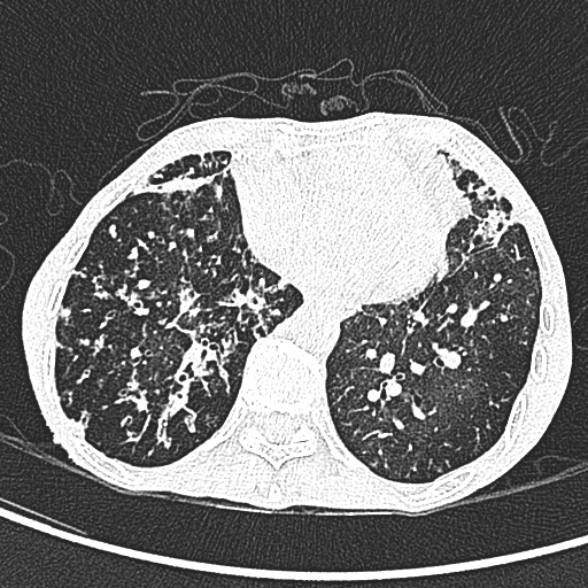Aspergilloma- with Monod sign (Radiopaedia 44737-48532 Axial lung window 196).jpg
