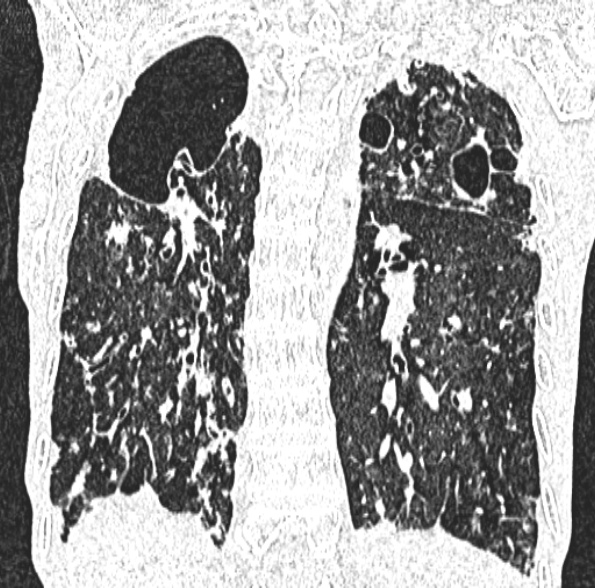 Aspergilloma- with Monod sign (Radiopaedia 44737-48532 Coronal lung window 325).jpg