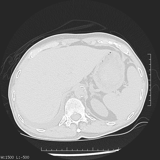 Aspergilloma (Radiopaedia 75184-86270 Axial lung window 53).jpg