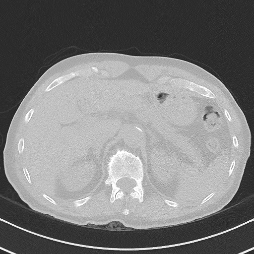 Aspergilloma on background pulmonary fibrosis (Radiopaedia 60942-68757 A 57).jpg