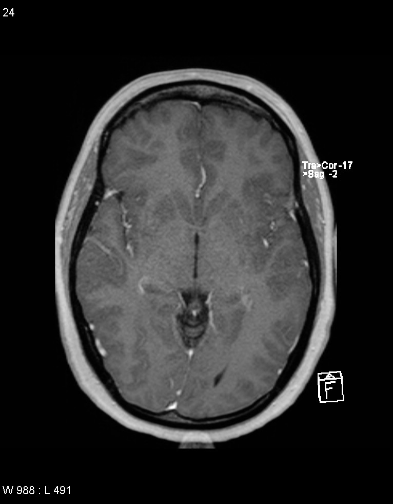 Astroblastoma (Radiopaedia 39792-42217 Axial T1 C+ 23).jpg
