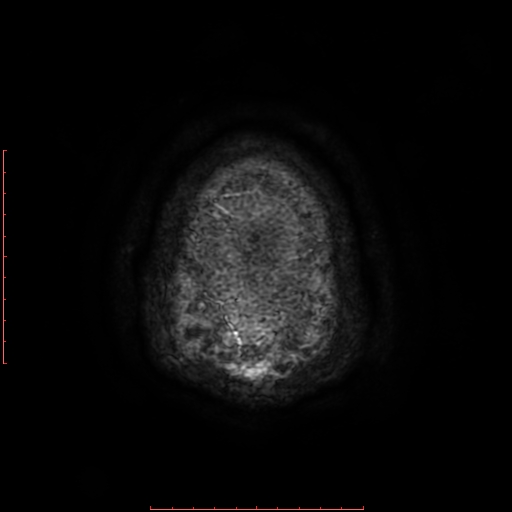 Astrocytoma NOS - cystic (Radiopaedia 59089-66384 Axial SWI 74).jpg