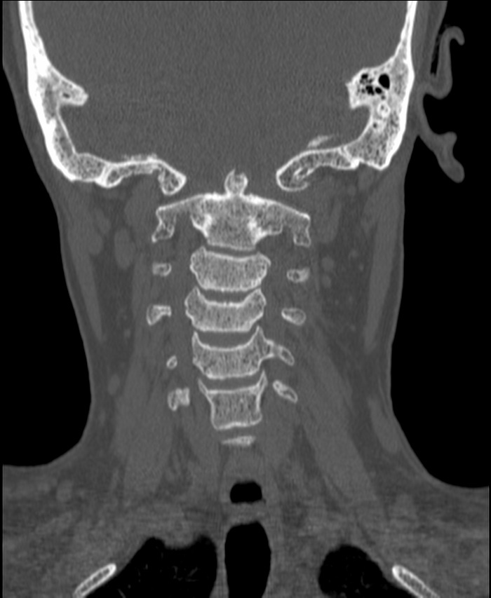 Atlanto-occipital assimilation with basilar invagination (Radiopaedia 70122-80188 Coronal bone window 102).jpg