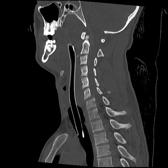 Atlanto-occipital dissociation (Traynelis type 1), C2 teardrop fracture, C6-7 facet joint dislocation (Radiopaedia 87655-104061 Sagittal bone window 34).jpg
