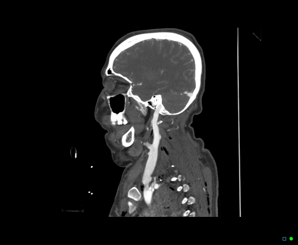 Atlanto-occipital dissociation - Traynelis type 1 (Radiopaedia 87570-103949 C 22).jpg