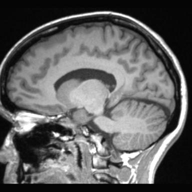 File:Atretic encephalocoele with inferior vermis hypoplasia (Radiopaedia 30443-31108 Sagittal T1 55).jpg