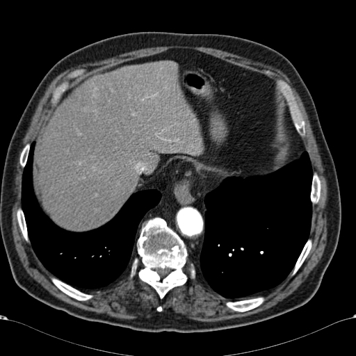Atypical hepatocellular carcinoma (Radiopaedia 41744-44698 A 14).jpg