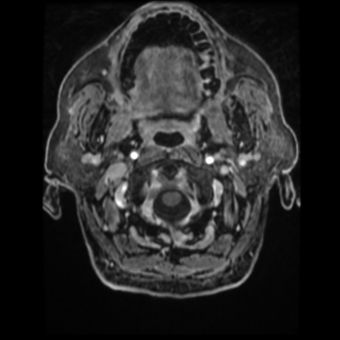 Atypical meningioma (Radiopaedia 45535-49629 Axial T1 C+ 13).jpg