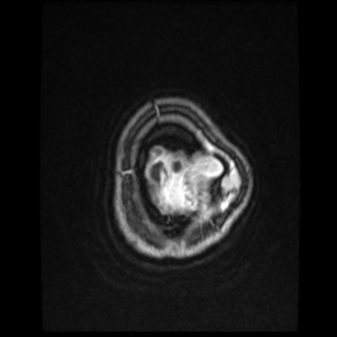 Atypical meningioma (Radiopaedia 45535-49629 Axial T1 C+ 62).jpg