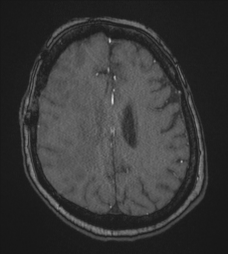 Atypical meningioma (WHO Grade II) (Radiopaedia 54742-60981 Axial MRA 69).png