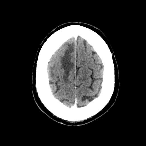 File:Atypical meningioma (WHO grade II) with brain invasion (Radiopaedia 57767-64728 Axial C+ 10).png