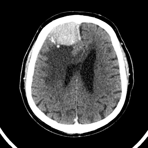 File:Atypical meningioma (WHO grade II) with brain invasion (Radiopaedia 57767-64728 Axial C+ 20).png