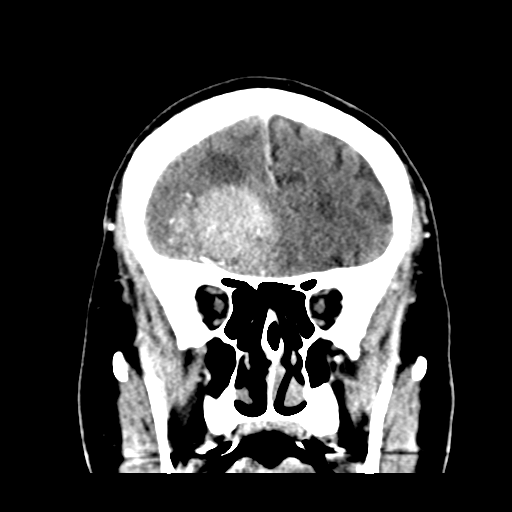 Atypical meningioma (WHO grade II) with brain invasion (Radiopaedia 57767-64728 Coronal C+ 18).png