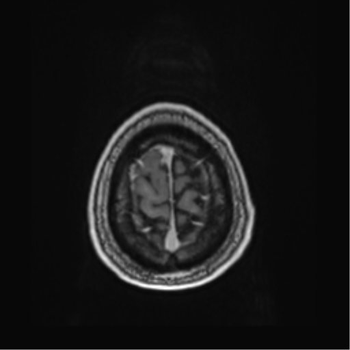 File:Atypical meningioma (WHO grade II) with brain invasion (Radiopaedia 57767-64729 Axial T1 C+ 47).png