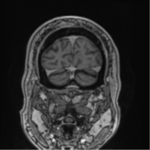 File:Atypical meningioma (WHO grade II) with brain invasion (Radiopaedia 57767-64729 Coronal T1 C+ 76).png