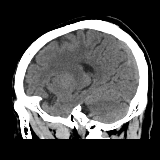 Atypical meningioma (WHO grade II) with osseous invasion (Radiopaedia 53654-59715 C 36).png