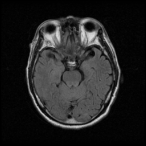 File:Atypical meningioma with skull invasion (Radiopaedia 34357-35648 Axial FLAIR 8).png