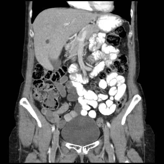File:Atypical renal cyst (Radiopaedia 17536-17251 C 26).jpg