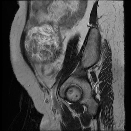 File:Atypical retroperitoneal lymphocoeles with large leiomyoma of uterus (Radiopaedia 32084-33027 Sagittal T2 27).jpg