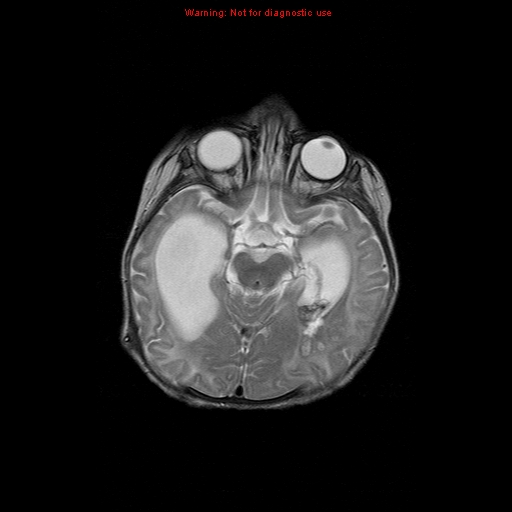 File:Atypical teratoid rhabdoid tumor (Radiopaedia 10712-11183 Axial T2 11).jpg
