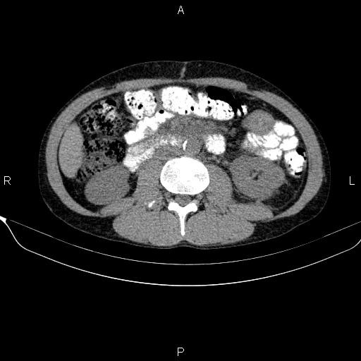Autoimmune pancreatitis (Radiopaedia 84925-100431 Axial non-contrast 29).jpg